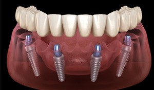Digital image of implant dentures