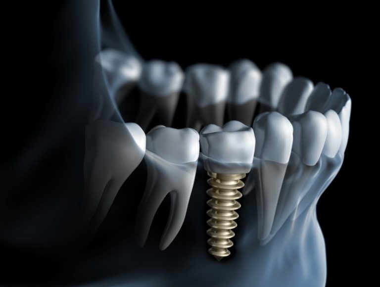 dental-implants-common-problems-dr-shelly-strohman